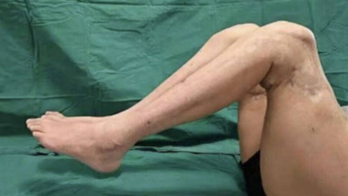 Factory worker's legs reattached in world first after being sliced in half